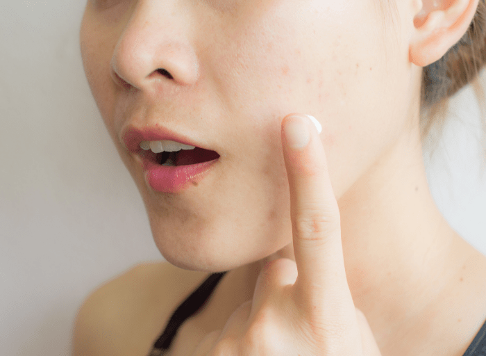 Acne Derm na trądzik i przebarwienia – efekty